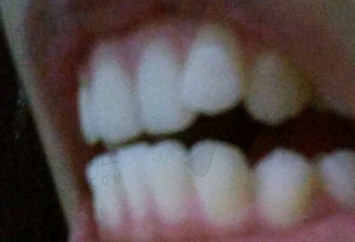 假牙半固定和固定的区别,活动假牙和固定假牙的区别